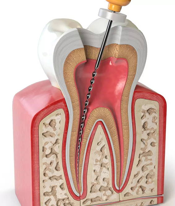 endodontics2